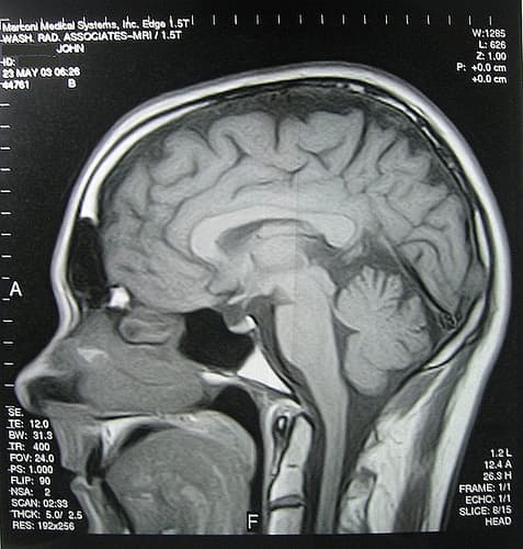 Wet Brain – Alcoholism and Wernicke-Korsakoff Syndrome